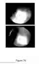 Fig. 32 - MULTILAYERED RETINAL CELL IMPLANT