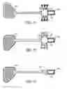 Fig. 08 - Cortical visual prosthesis