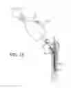 Fig. 12 - Method and apparatus for extraction of medical implants