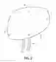 Fig. 04 - Action/counteraction superimposed double chamber broad area tissue ablation device