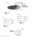 Fig. 02 - Method and device for female urinary incontinence