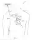 Fig. 02 - Adaptive cardiac resynchronization therapy