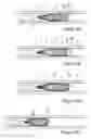 Fig. 08 - Devices and methods for minimally invasive tissue removal