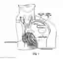 Fig. 02 - Lead extraction methods and apparatus