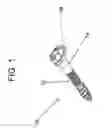 Fig. 02 - FACET FIXATION PROSTHESIS