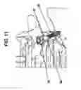 Fig. 08 - FACET FIXATION PROSTHESIS