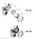 Fig. 06 - HYDROGEL ARTHROPLASTY DEVICE