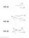 Fig. 10 - HYDROGEL ARTHROPLASTY DEVICE