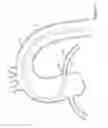 Fig. 02 - Guide extension catheter