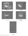 Fig. 09 - Implants with wear resistant coatings and methods