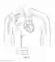 Fig. 02 - Devices, methods and systems for counterpulsation and blood flow conduit connection