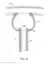 Fig. 08 - Devices, methods and systems for counterpulsation and blood flow conduit connection