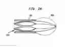 Fig. 17 - Heart assist device with expandable impeller pump