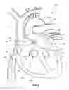 Fig. 05 - Ventricular assist device and related methods