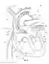 Fig. 09 - Ventricular assist device and related methods