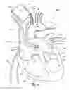 Fig. 11 - Ventricular assist device and related methods