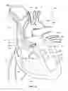 Fig. 12 - Ventricular assist device and related methods