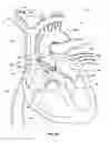 Fig. 15 - Ventricular assist device and related methods