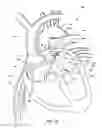 Fig. 16 - Ventricular assist device and related methods