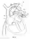 Fig. 17 - Ventricular assist device and related methods