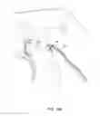 Fig. 24 - Zone heating for respiratory circuits