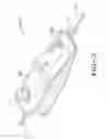 Fig. 04 - Balloon catheter having a retractable sheath and locking mechanism with balloon recapture element