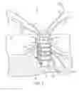 Fig. 03 - Anti-backup suture anchor