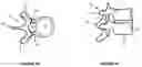 Fig. 02 - Methods, systems, and devices for diagnosing and treating intervertebral disc degeneration