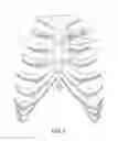 Fig. 02 - Device and system for supporting and approximating ribs