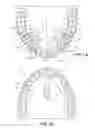 Fig. 02 - System and Method of Installing Dental Prostheses for Passively Influencing Tongue Position to Reduce Airway Obstruction