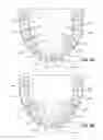 Fig. 05 - System and Method of Installing Dental Prostheses for Passively Influencing Tongue Position to Reduce Airway Obstruction