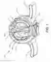 Fig. 02 - Artificial urinary sphincter device