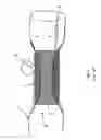 Fig. 02 - Suction stent, stent system, and method for sealing a leakage
