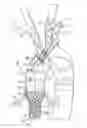 Fig. 01 - Debranching visceral stent graft and methods for use