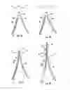 Fig. 07 - Bifurcated medical device for treating a target site and associated method