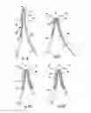 Fig. 08 - Bifurcated medical device for treating a target site and associated method