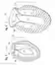 Fig. 02 - Methods for repairing mitral valves