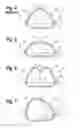 Fig. 04 - Methods for repairing mitral valves