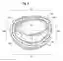 Fig. 05 - Methods for repairing mitral valves