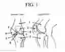 Fig. 02 - Cartilage prosthetic implant
