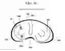 Fig. 09 - Cartilage prosthetic implant