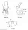 Fig. 03 - Systems and methods for providing a femoral component having a modular stem