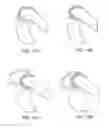 Fig. 17 - Systems and methods for providing a femoral component having a modular stem