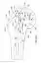 Fig. 77 - Systems and methods for providing a femoral component having a modular stem