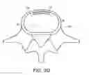 Fig. 06 - In-situ formed intervertebral fusion device and method