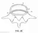 Fig. 07 - In-situ formed intervertebral fusion device and method