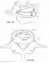 Fig. 08 - In-situ formed intervertebral fusion device and method