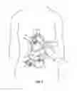 Fig. 09 - Surgical sponge