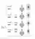 Fig. 03 - Cancer cell targeting using nanoparticles