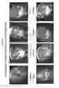 Fig. 02 - Method for Cancer Therapy Based on Co-Administration of a Parvovirus and a Cytokine